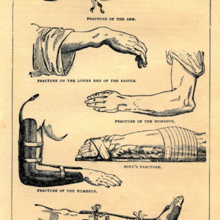 Vintage Medical Illustration of Fractures