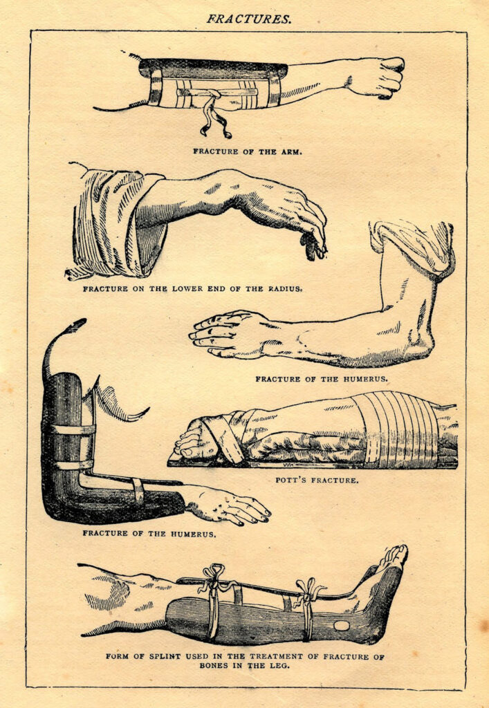 Vintage Medical Illustration of Fractures