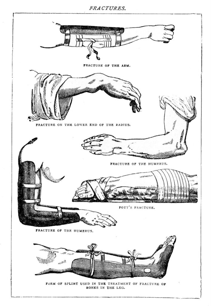 Small black and white picture of fractures